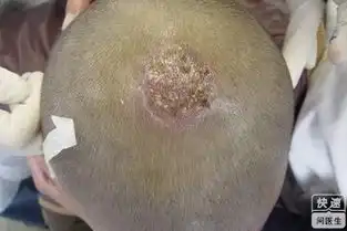  儿童头癣的治疗方法推荐五个护理儿童头癣的方法