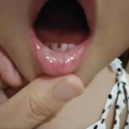  孩子嘴里长了小白点要小心可能是鹅口疮惹的祸