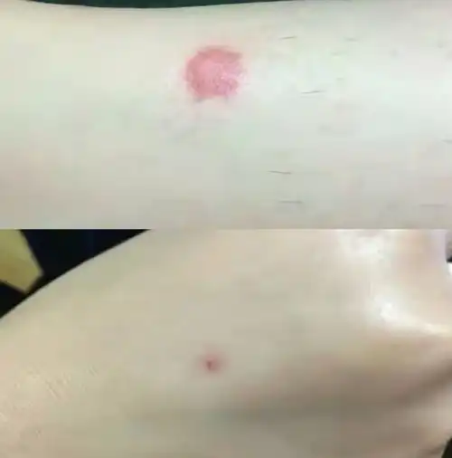 同样被蚊子咬,大肿包代表身体虚,小红点说明身体好