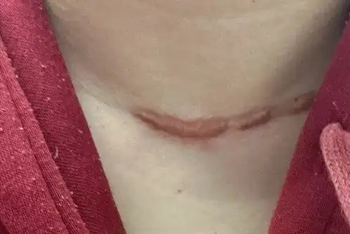  甲状腺术后疤痕增生又丑又痛每天3次,30天轻松修复不复发