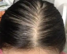  女子产后脱发险变斑秃,丈夫做了2件事,头发乌黑浓密,身材好