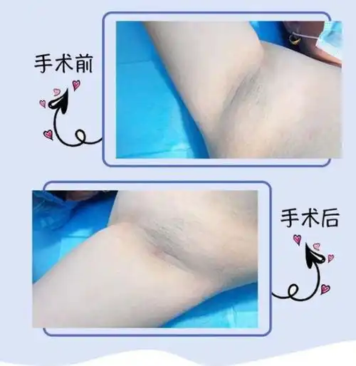  腋臭手术