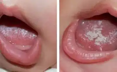  菊花晶清火宝能去火都是没用又坑娃的垃圾产品