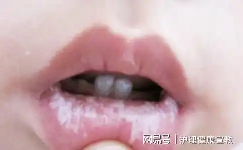  宝宝口腔里长了鹅口疮,应该如何治疗