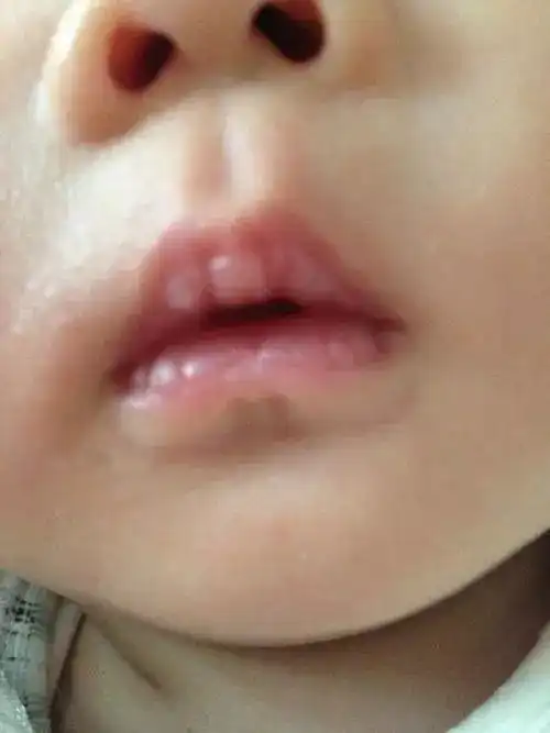  史上最全的护理方法包含03岁宝宝常见疾病湿疹,腹泻,发烧,咳嗽...