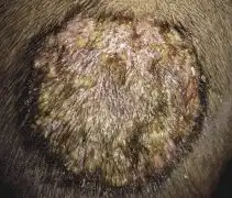  皮肤健康网专家介绍头癣早期症状分为哪四种类型
