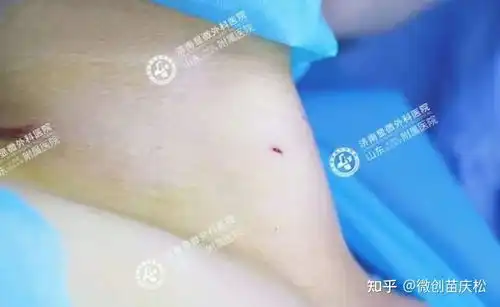  超微创微波消融术不开刀不留疤,爱美女士的新福音