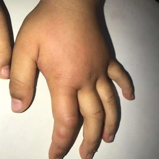  宝宝手被蚊子叮了一下肿的老高,妈妈却用嘴吸毒素......