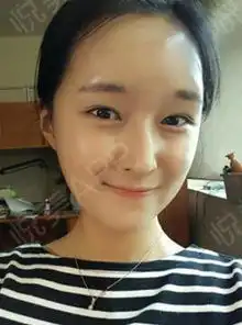  做了脂肪后自己也爱上了自拍,再也不用为ps照片发愁了...自体脂肪悦美整形