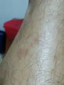  被狗牙划破皮伤口是什么样的,我腿上有一个像痘痘破了的圆圆的小孔,我怕是上次骑车的时候被一条狗刮到的