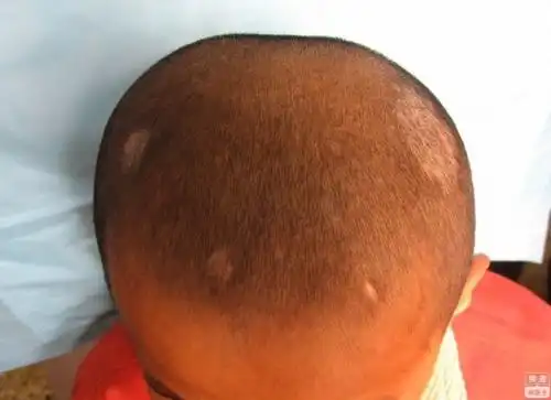  黄癣黑癣与脱发的关系