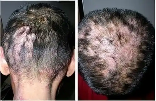  头皮老是长疙瘩和脓包,提醒别大意,或许潜伏了3种病
