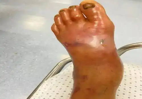  一大爷脚上沾了这种水,几天后险截肢夏天高发医生紧急提醒