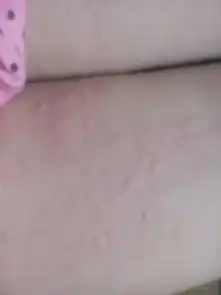  就是这几天只要一睡觉,醒来过后腿上就会有类似于被蚊子叮了的包,可是又有很多,不知道是什么