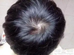  女性斑秃吃什么好