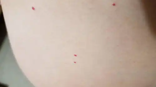  这是被蚊子咬的红点都快一年多了为什么一直还没有消除,请问各位有什么好的方法谢谢