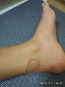  在泰国被蚊子咬了起水泡很痒
