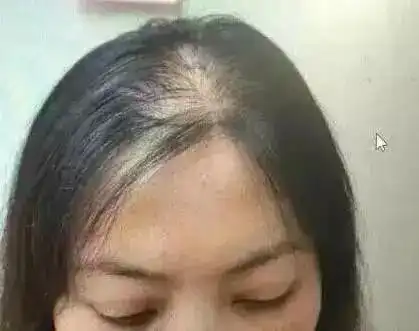  秋冬疯狂掉发,该拿什么拯救我们的发际线秃顶这里有妙招
