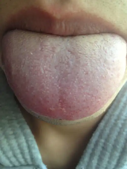  我这是艾滋病舌头症状吗