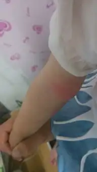  小孩被蚊子咬了肿了是不是正常