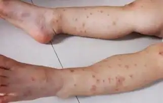  蚊子咬得宝宝又红又肿,老中医2种药草抹一抹,很快消不留疤