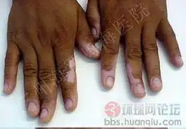  白癜风症状只是很霸道的相册