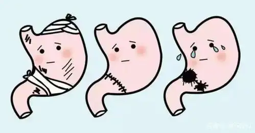 胃部长期不适,最后竟然发现是胃癌  胃部长期不适,最后竟然发现是胃癌