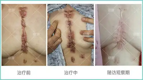  前胸因痤疮导致疤痕疙瘩,4次非手术治疗后恢复良好