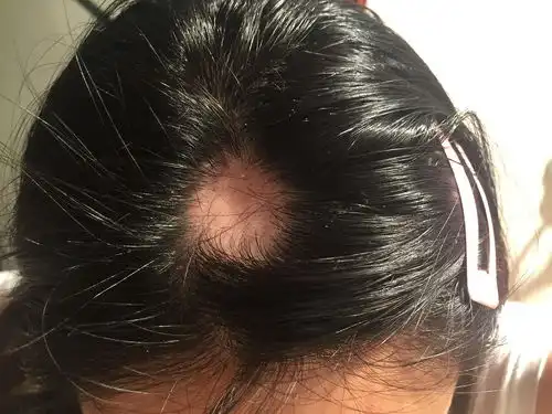  戴帽子会导致脱发秃顶脱发这件事男性激素很关键,如何预防