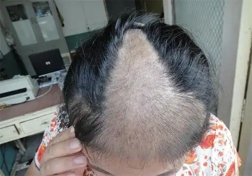  头皮里,老是长疙瘩和脓包,是怎么了提醒或是3种疾病警报