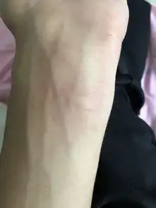  刚被蚊子咬了手腕很快几分钟肿这么大w我还按了几下