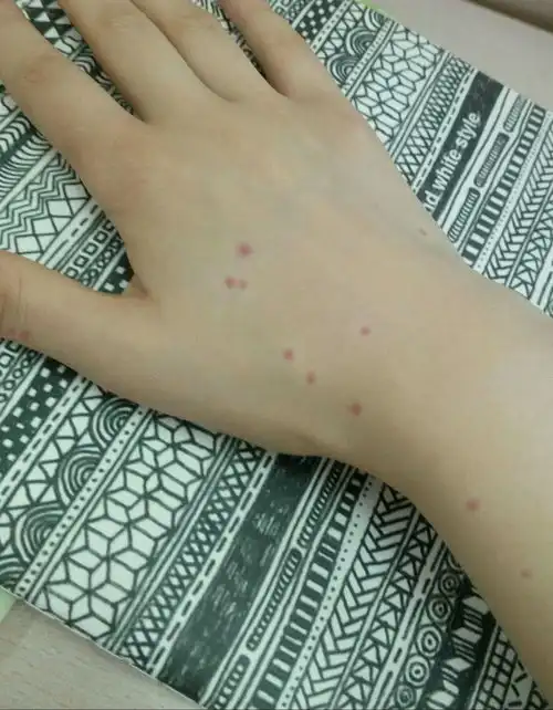  为什么有的人被蚊子咬了就出现疙瘩而且很痒,有些人就只是出现红点而且完全不痒