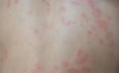  你以为身上的包都是蚊子咬的只送给那些爱美的女孩