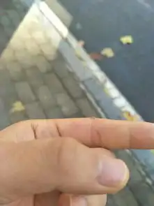 手肘关节鼓了个包图片