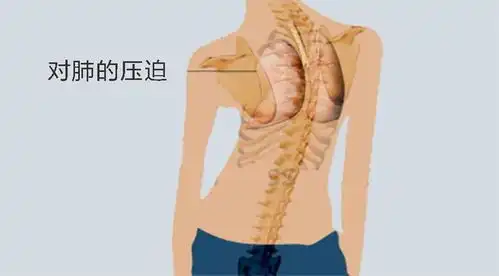 脊椎侧弯正确睡姿图