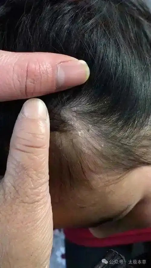  牛皮癣头癣外用效验方