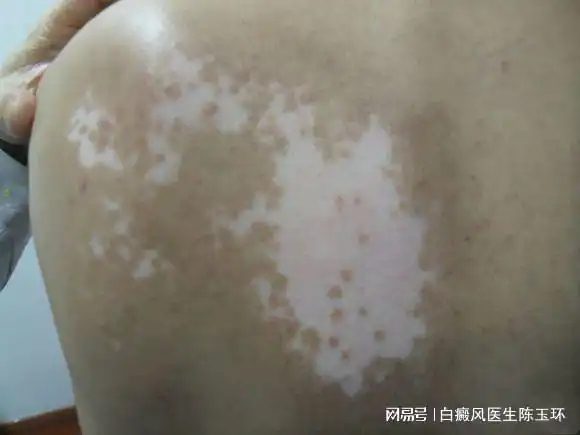  头部白癜风治疗多久能康复跟这3个因素有关,你还不知道吗