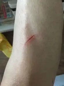 小腿被生锈的铁片划伤了,出了点血,用清水清洗过,碘酒擦过了,还要打破伤风吗