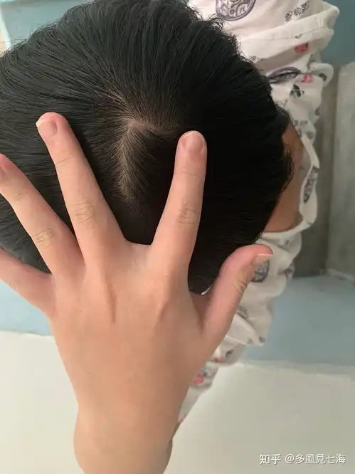  什么样子的发旋是正常的啊