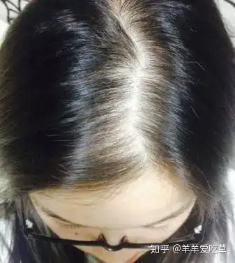  男性秃顶,女性头发稀疏,这两个现象是什么原因