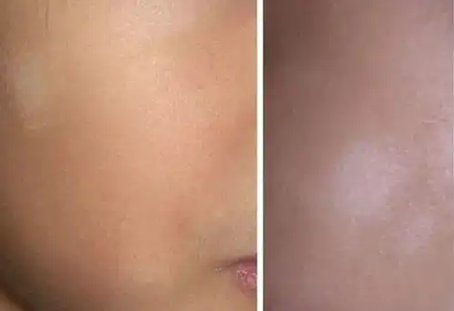 孩子脸上有白斑是蛔虫作怪你需要做好这2件事问答