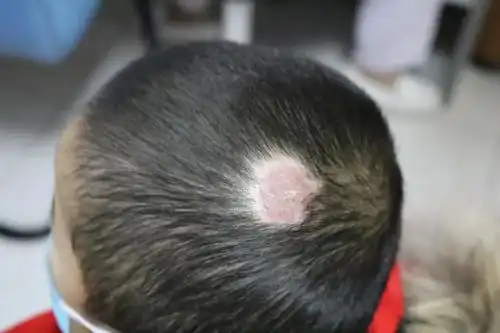  儿子头皮长包化脓治不好,罪魁祸首竟是家里的它.....