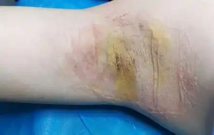  频繁刮腋毛,腋下汗臭味会越来越重