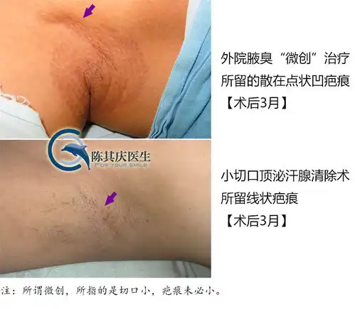  微创腋臭手术和小切口腋臭根治术痕迹对比