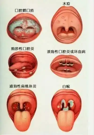  宝宝鹅口疮,可别不当回事
