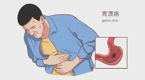 反复胃痛让他的胃破了个洞丨每日话题 反复胃痛让他的胃破了个洞丨每日话题