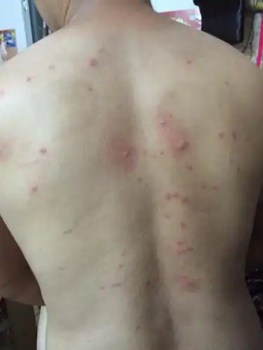  身上长有像蚊子咬的包包一样,奇痒无比是荨麻疹吗治疗方法有