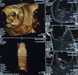  科学家用x光扫描确定千年儿童木乃伊性别