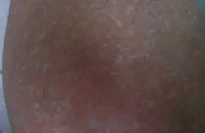  糖尿病会引发白癜风吗