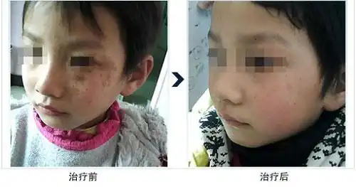 正月剪头搞笑图片激光治